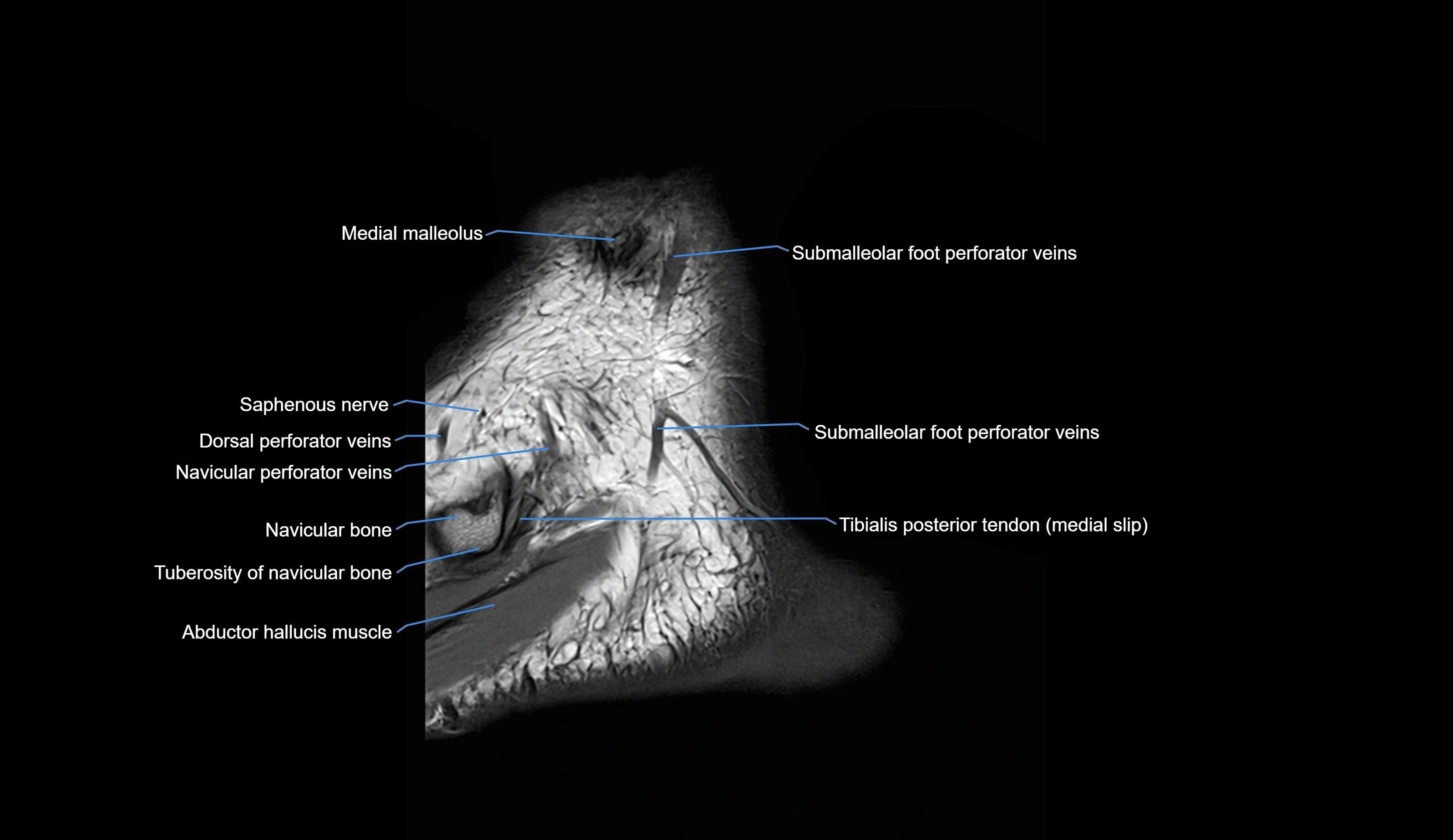 MRI Ankle sagittal cross sectional anatomy 3T  radiology  image-img-00001-00002.webp